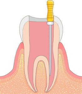 できるだけ歯を残す根管治療