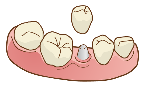 インプラント