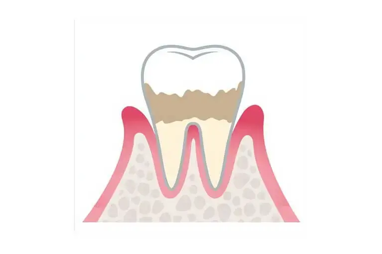軽度歯周炎