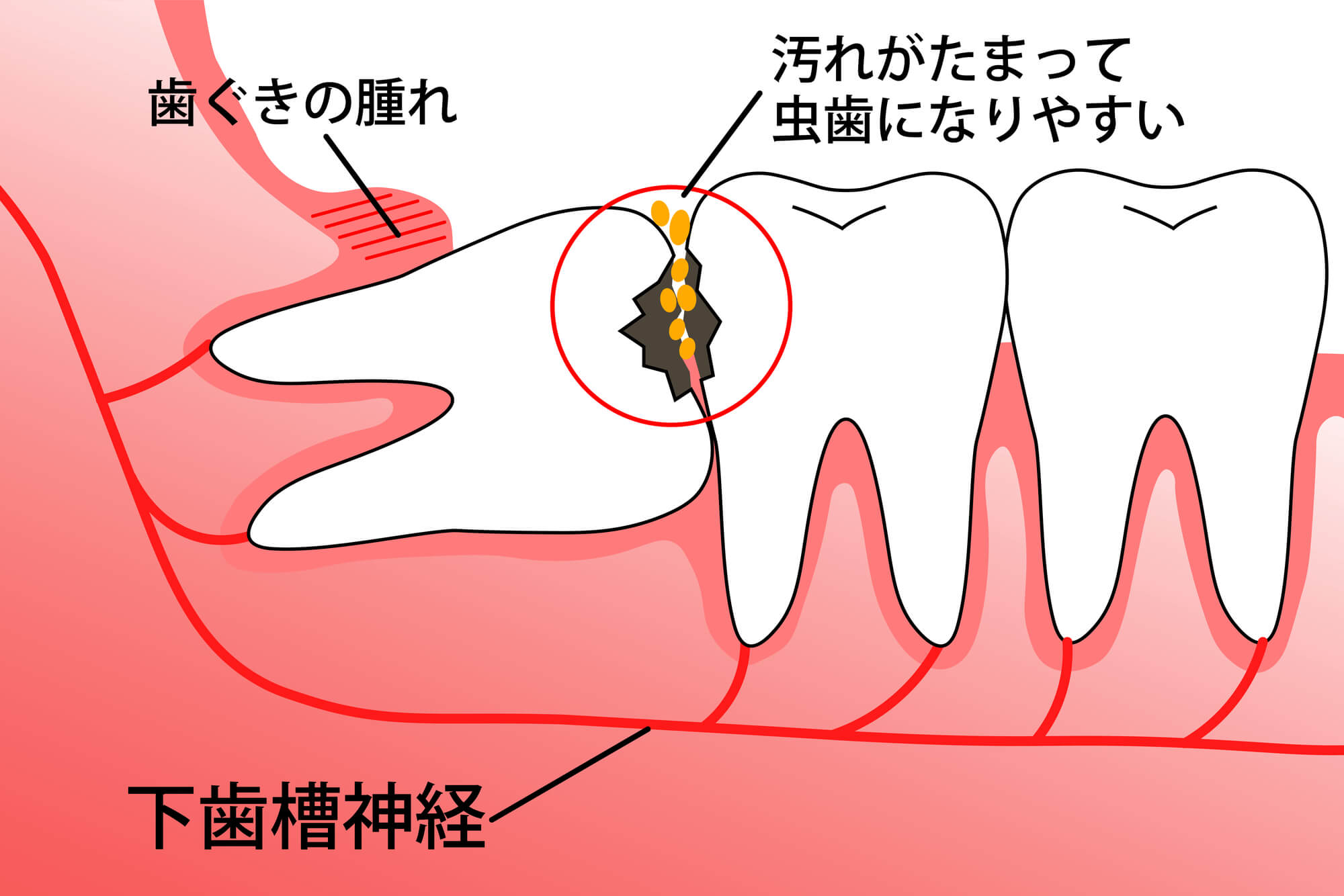 親知らずは抜いたほうがいい？