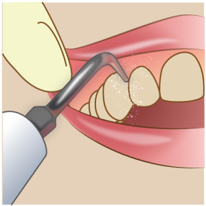 歯石除去は保険適応？